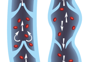 Ce dessin montre 2 veines: Une saine et une autre souffrant d'insufficance cardiovasculaire comme les jambes lourdes